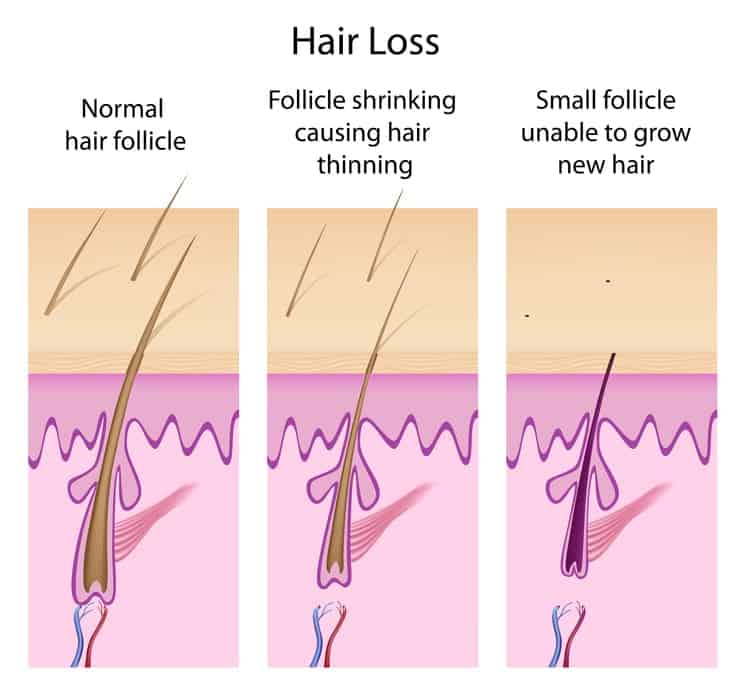 Hair Loss Causes in Women