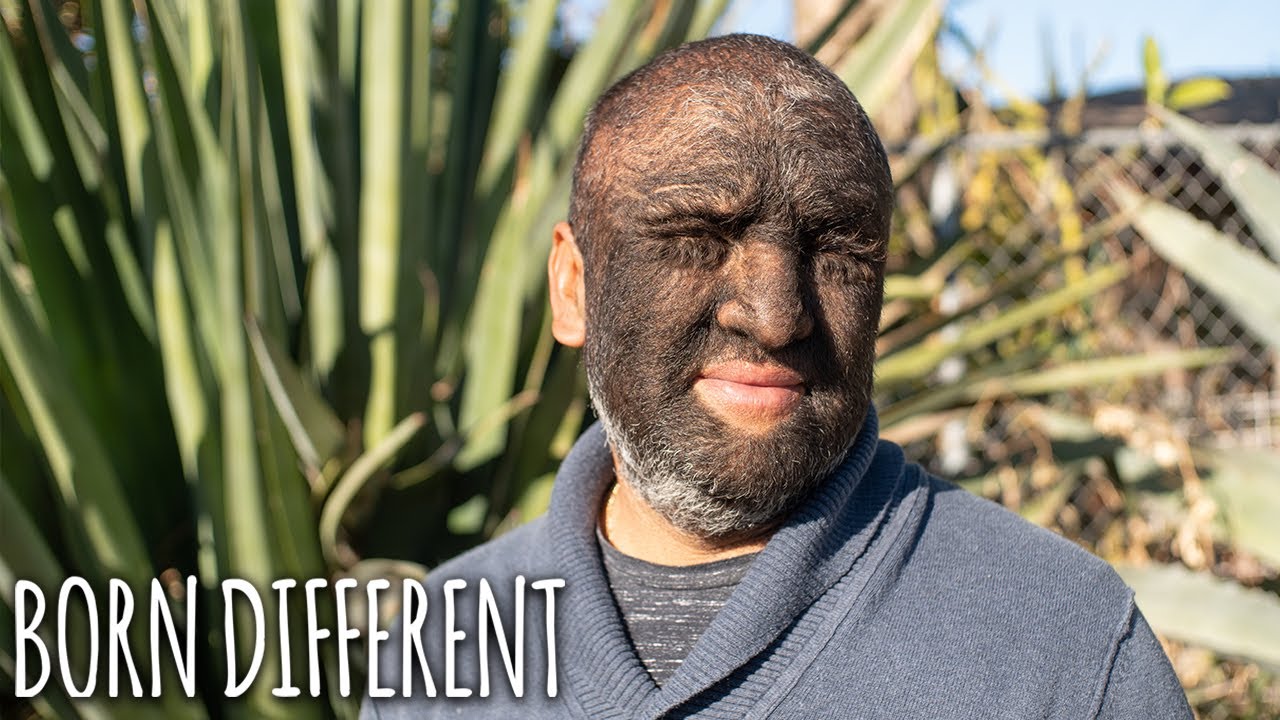 'Wolf Man' Is 95% Covered In Hair | BORN DIFFERENT