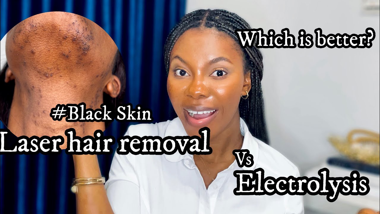 Laser hair Versus Electrolysis of hair removal on black skin | Understanding facial hair .