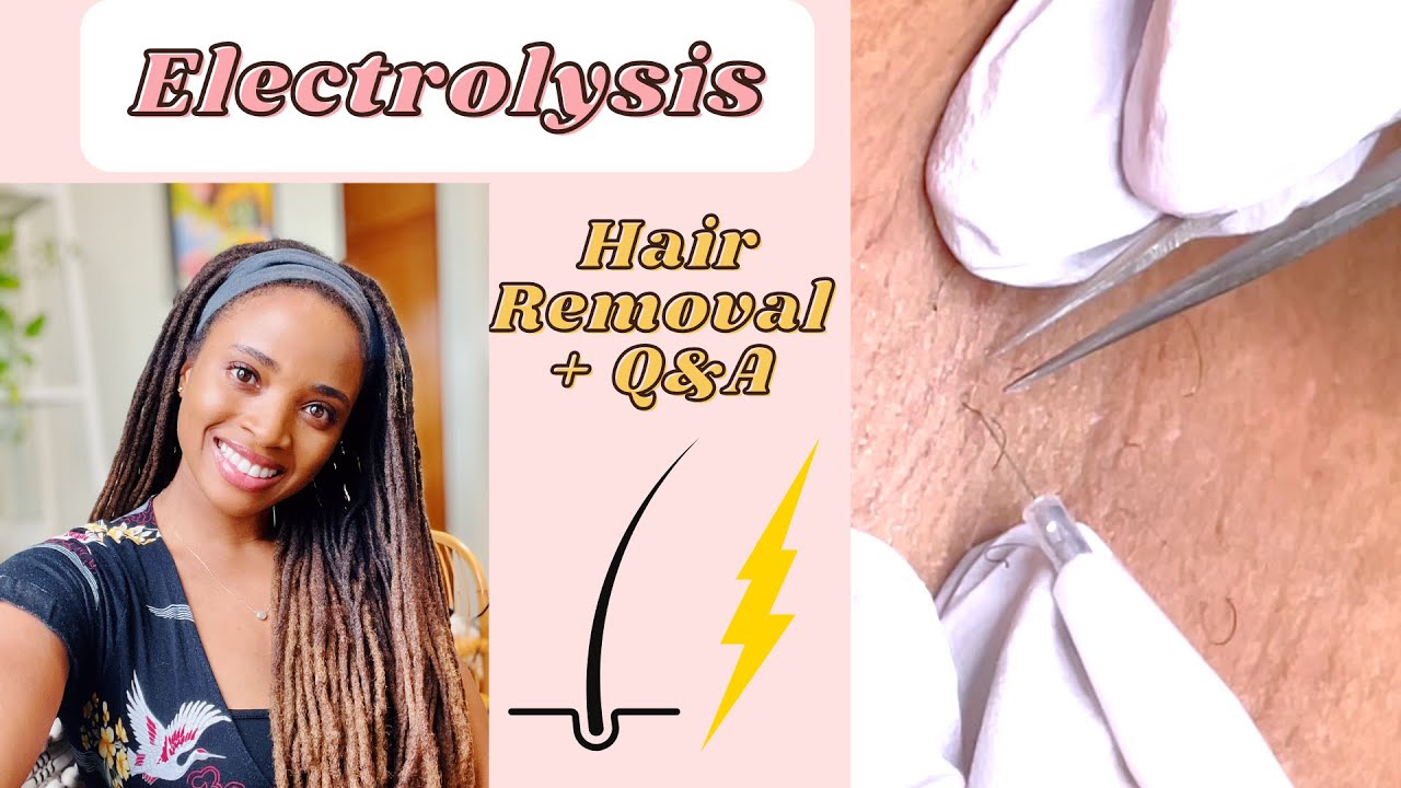 Electrolysis PERMANENT HAIR REMOVAL | Watch me get treated + Questions & Answers