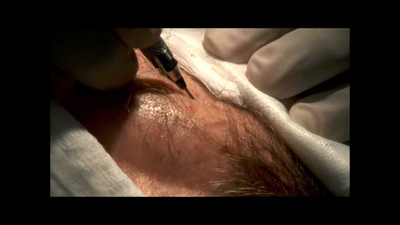 FUT Hair Transplant Surgery Performed at Bosley Medical: Before and After