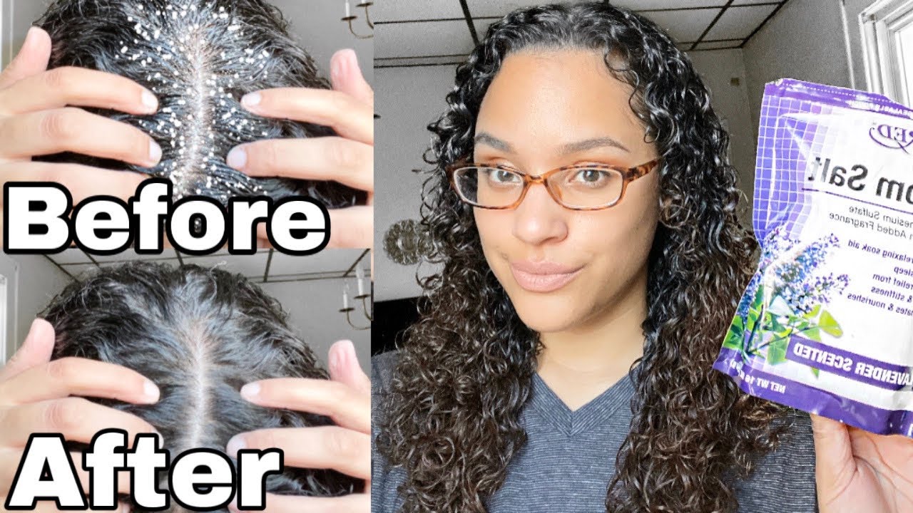 EPSOM SALT SCALP SCRUB [Before + After]