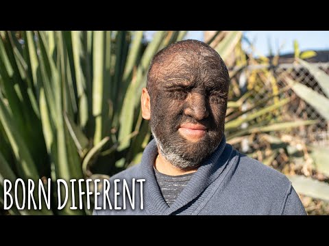 'Wolf Man' Is 95% Covered In Hair | BORN DIFFERENT