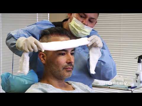 Bosley FUE Procedure Edgar's Journey (Hair Transplant - How It's Done)