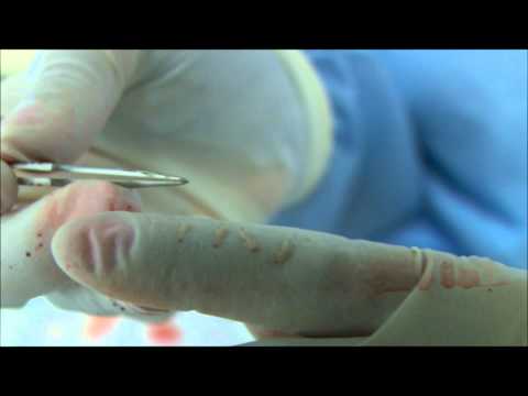 How A Follicular Unit Extraction (FUE) Procedure is Performed - Bosley Medical