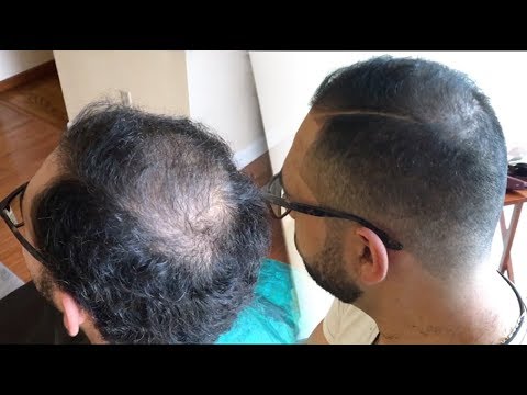How to Cut and Fade Balding Hair