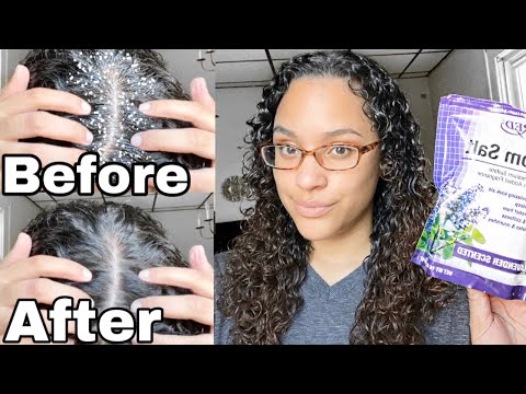 EPSOM SALT SCALP SCRUB [Before + After]