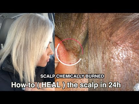 Severe Scalp Chemically Burned | How to heal the scalp after bleached your hair ( it work )