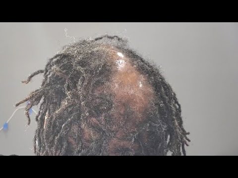 HAIR LOSS, LOCS AND HOW TO STILL ENJOY YOUR LOC JOURNEY