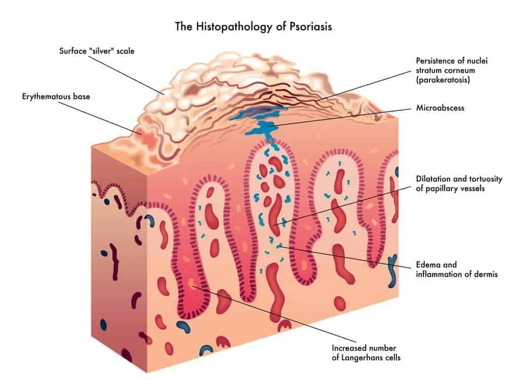 psoriasis dandruff