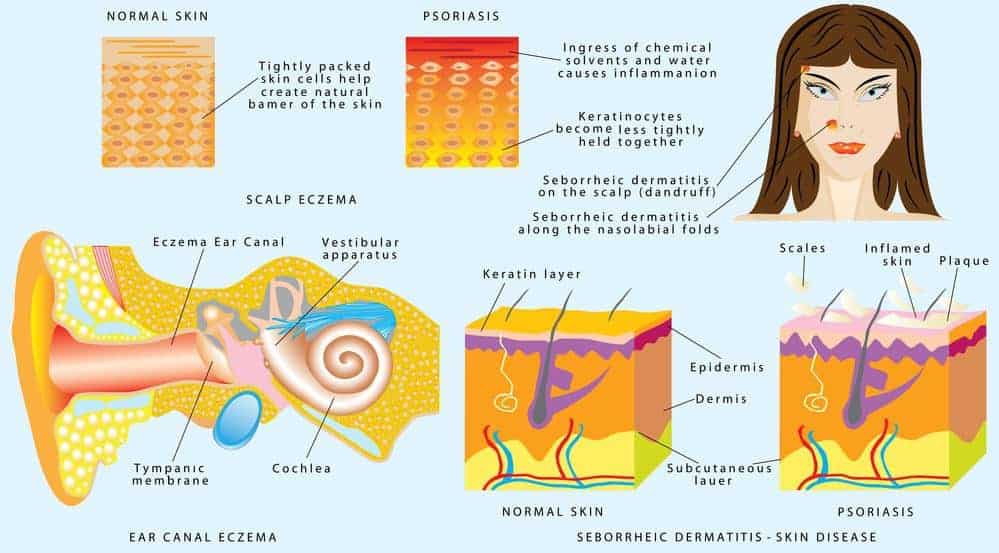 eczema skin dandruff