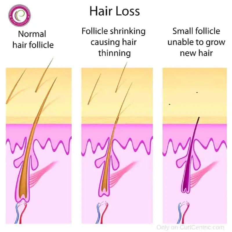 female-pattern-hair-loss