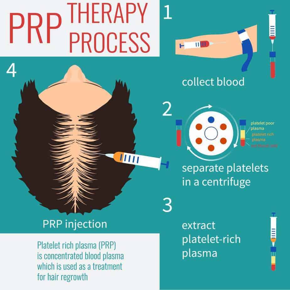 diagram of the platelet-rich plasma (PRP) process