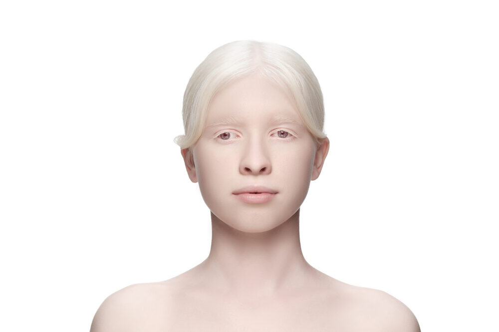Albino woman with blue eyes and a subtle smile preparing to have her hair dyed.