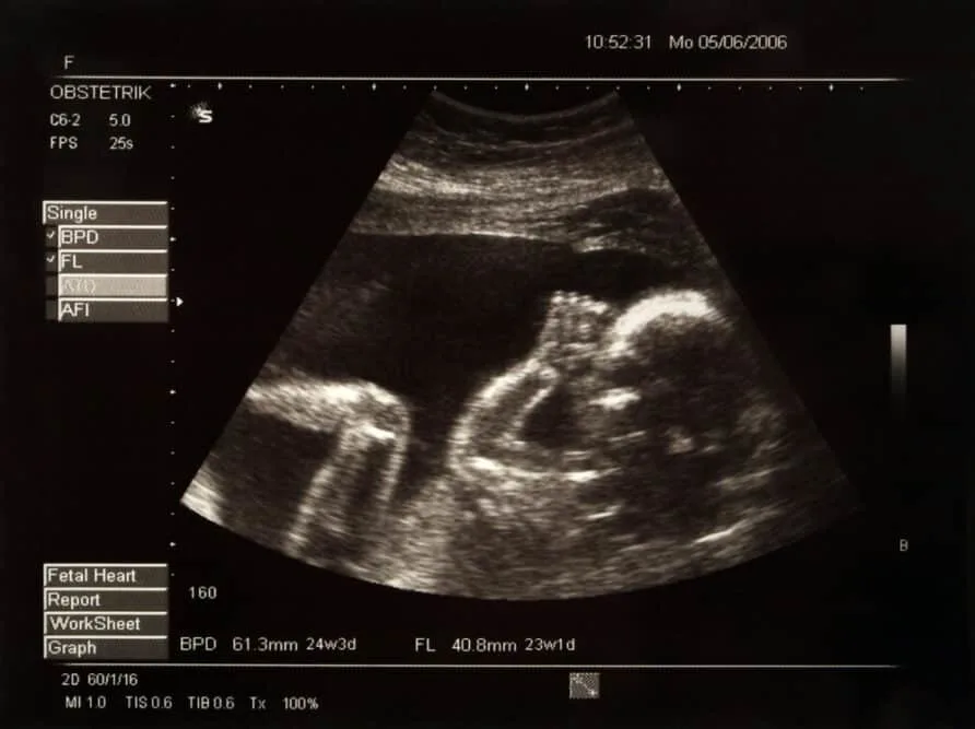 Baby Hair on Ultrasound vs When Born: When Can You Tell? 9 Doctor's visit showing a baby's hair on ultrasound vs when born as a mom approaches her due date.