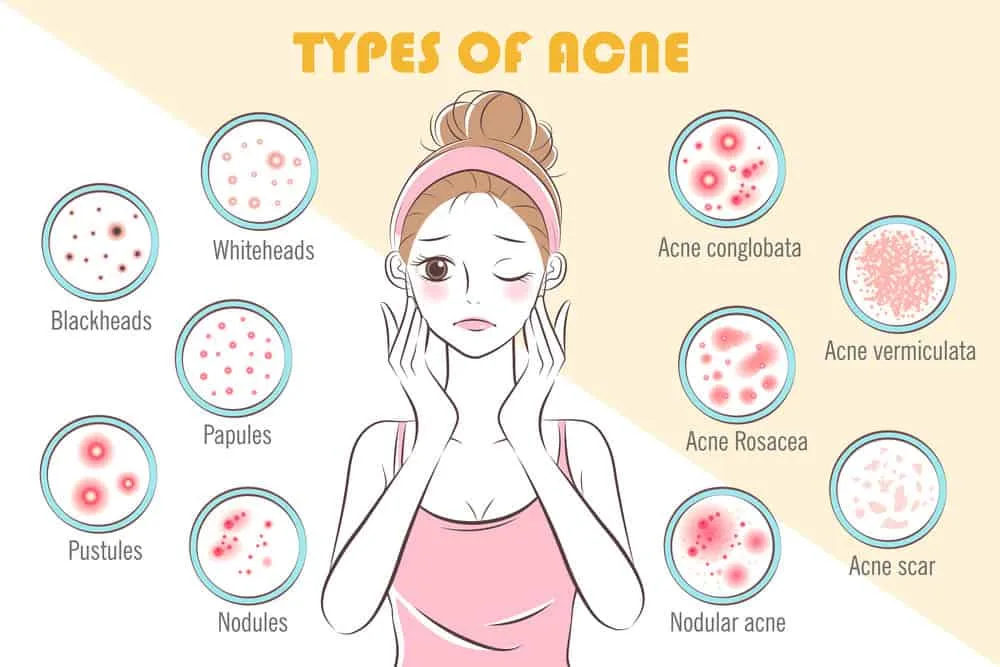 A diagram showing the different types of acne, including whiteheads, blackheads, papules, and pustules.