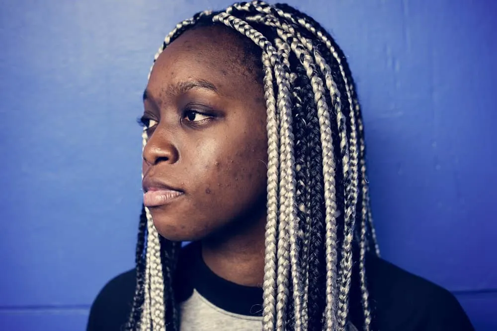 African American female with clogged pores experiencing an acne breakout on her face and scalp from new braids.