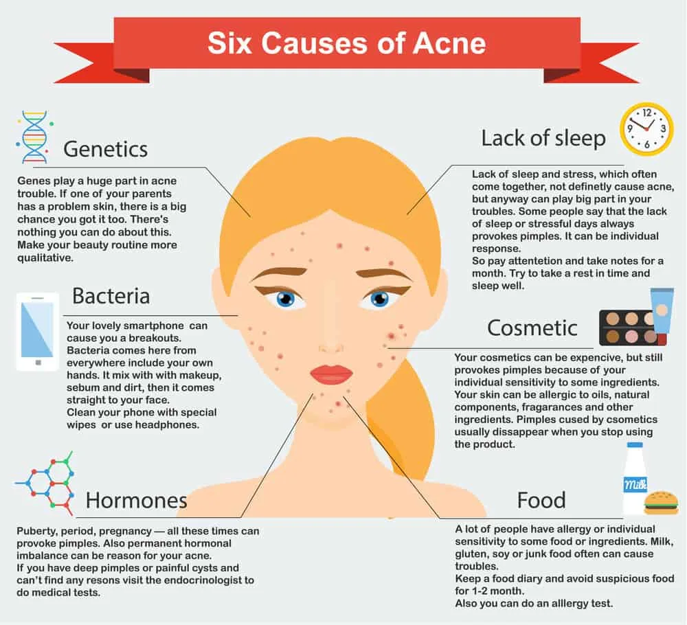 A diagram showing potential reasons that cause acne, from styling products to being irritated from excessive rubbing.